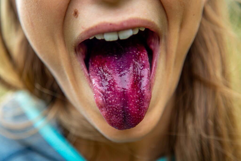 How to Squeeze Out Salivary Gland Stone guide to hydration, warm compresses, gentle massage, saliva flow, infection signs, and professional removal.