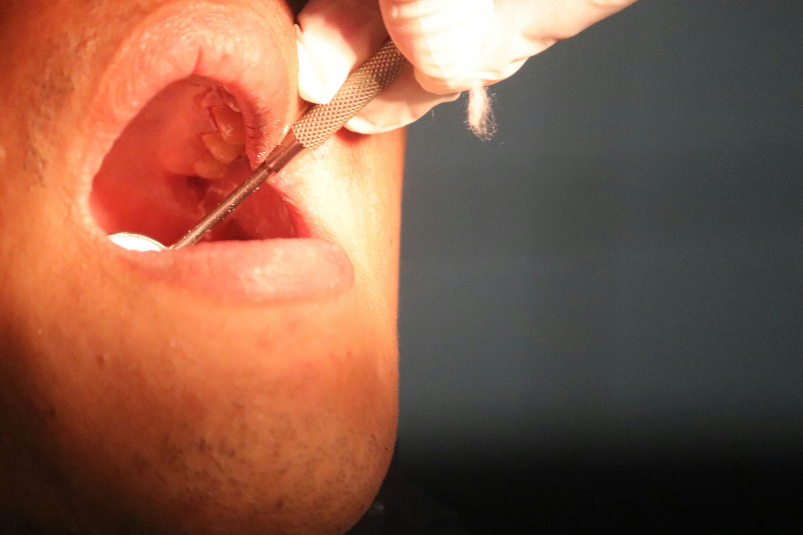 How to Squeeze Out Salivary Gland Stone: Safe Relief Guide