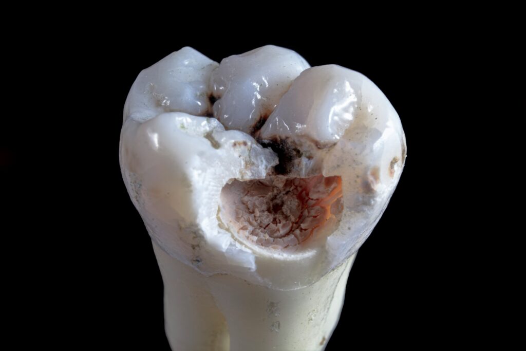Wisdom Tooth Hole Never Closed Years Later covering delayed healing, extraction sites, gum changes, inflammation, infection, discomfort, and dental care.
