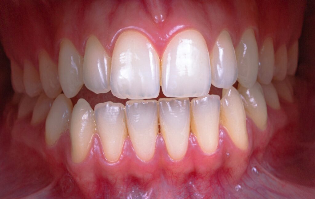How Long to Wait to Eat After Composite Filling? covering post-filling meals, food choices, chewing tips, sensitivity, aftercare, and dental care.
